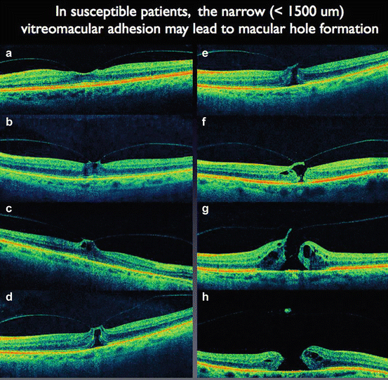 Surgical Management Of CME Associated With Vitreoretinal Interface ...