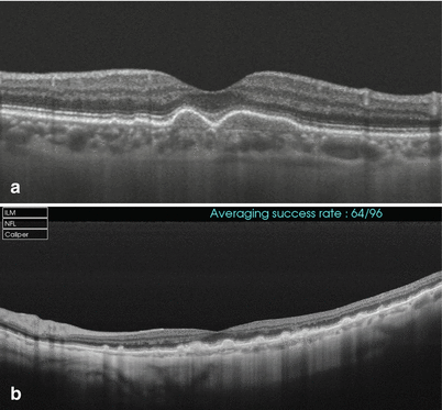 Neovascular Age-Related Macular Degeneration Studied With Swept Source ...