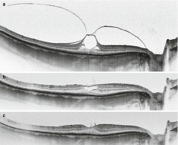 Vitreomacular Traction Syndrome | Ento Key