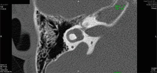 Classification Of Inner Ear Malformations | Ento Key