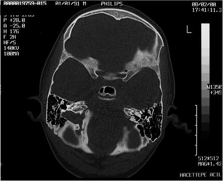 Classification Of Inner Ear Malformations | Ento Key