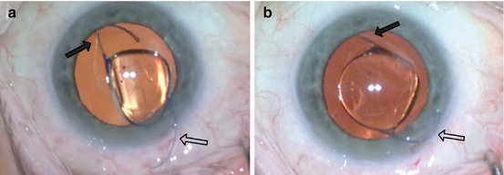 Intraocular Lens Insertion | Ento Key