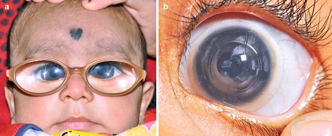 Nystagmus In The Child With Congenital Cataract | Ento Key