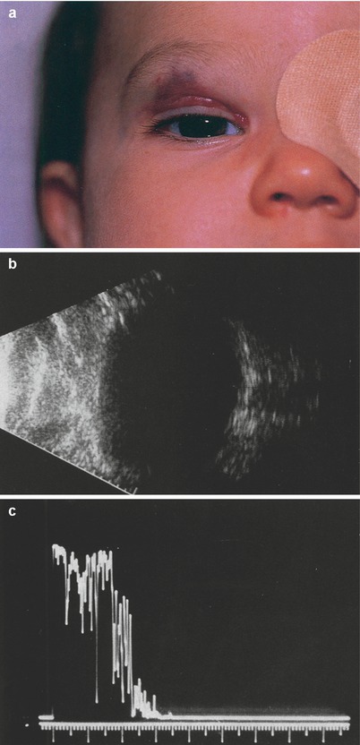 Benign Pediatric Eyelid Tumors | Ento Key