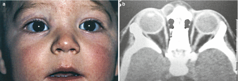 Benign Pediatric Orbital Tumors | Ento Key