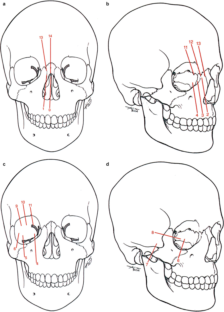 Congenital Craniofacial Deformities: Ophthalmologic Considerations ...