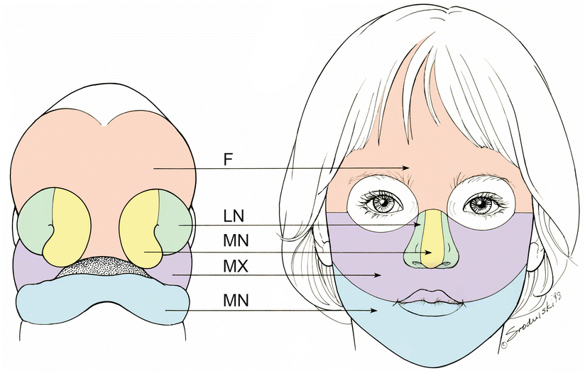 Congenital Craniofacial Deformities: Ophthalmologic Considerations ...