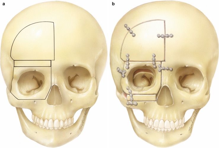 Oculoplastic Considerations In Pediatric Craniofacial Surgery | Ento Key