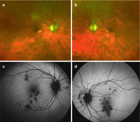 Fundus Autofluorescence Imaging In Posterior Uveitis | Ento Key