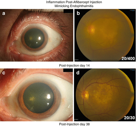 Differential Diagnosis Of Endophthalmitis | Ento Key