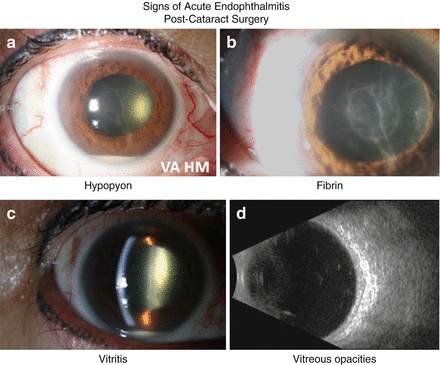 Diagnosis Of Endophthalmitis: Clinical Presentation, Microbiology, And ...