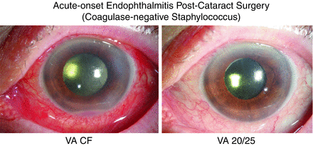 Endophthalmitis Clinical Categories (Incidence Rates, Signs/Symptoms ...