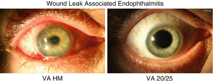 Endophthalmitis Clinical Categories (Incidence Rates, Signs/Symptoms ...