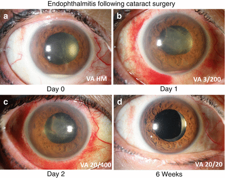 Endophthalmitis Clinical Categories (Incidence Rates, Signs/Symptoms ...