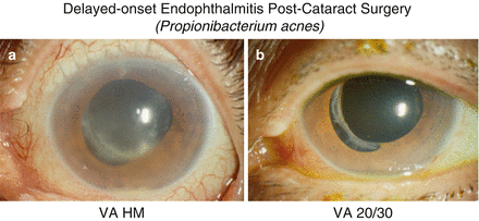 Endophthalmitis Clinical Categories (Incidence Rates, Signs/Symptoms ...