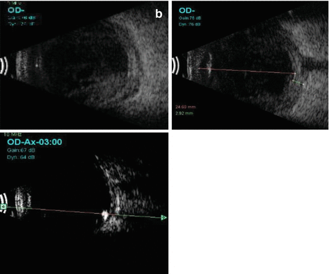 Management Of Endophthalmitis | Ento Key