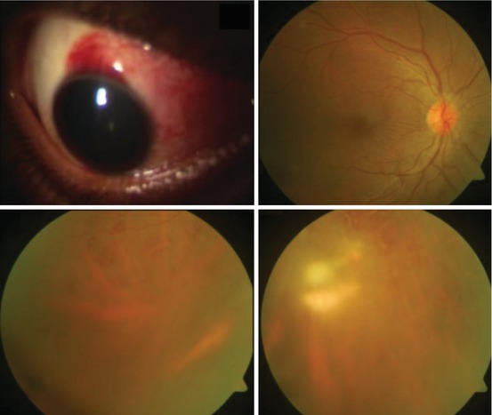 Post-cataract Surgery Endophthalmitis | Ento Key