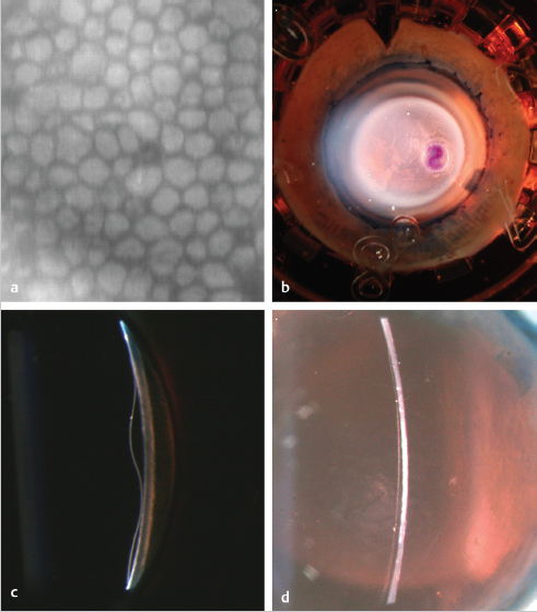 Descemet Membrane Endothelial Keratoplasty Surgical Technique | Ento Key