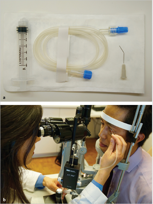 Descemet Membrane Endothelial Keratoplasty Surgical Technique | Ento Key