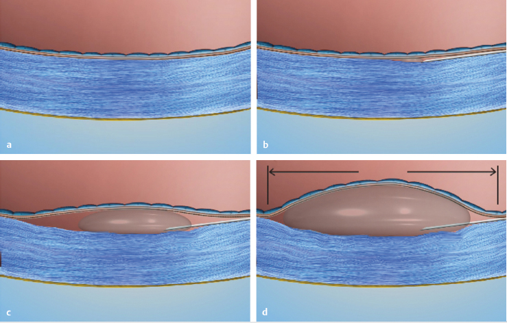 Pre-Descemet Endothelial Keratoplasty | Ento Key