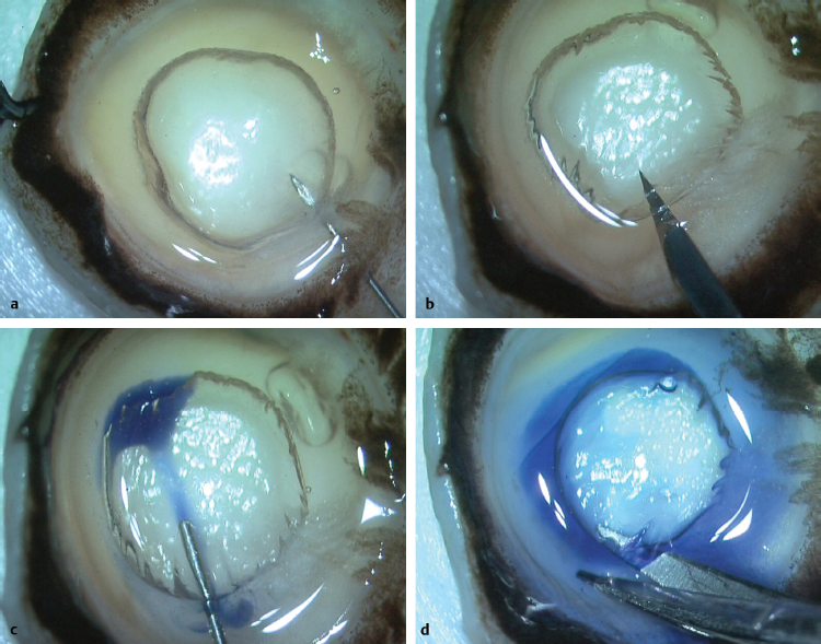 Pre-Descemet Endothelial Keratoplasty | Ento Key