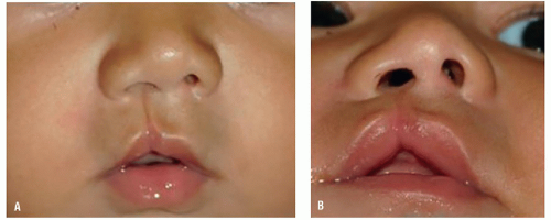 Cleft Lip And Palate | Ento Key