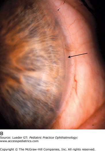 Diseases Of The Cornea | Ento Key