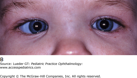 Strabismus, Amblyopia, And Nystagmus | Ento Key