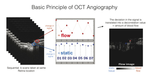 Optical Coherence Tomography Angiography: Understanding The Basics ...