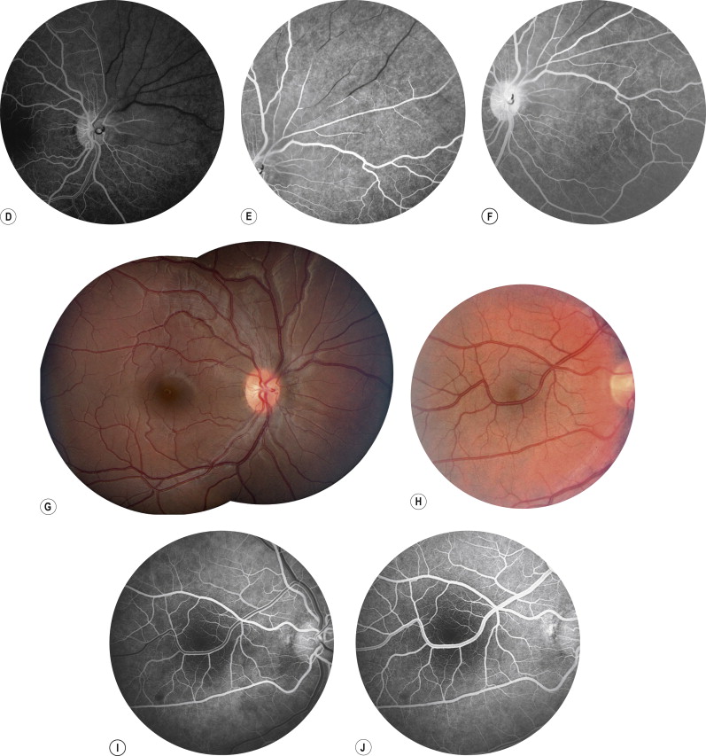 Macular Dysfunction Caused By Retinal Vascular Diseases | Ento Key