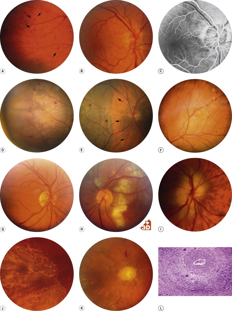 Macular Dysfunction Caused By Retinal Vascular Diseases | Ento Key