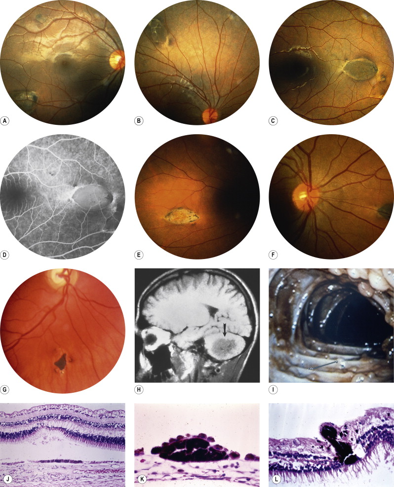 Tumors Of The Retinal Pigment Epithelium (RPE) | Ento Key