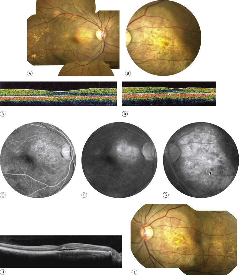 Neoplastic Diseases Of The Choroid | Ento Key