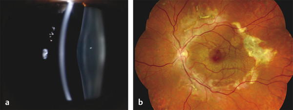 Stargardt Disease And Other ABCA4 Retinopathies | Ento Key