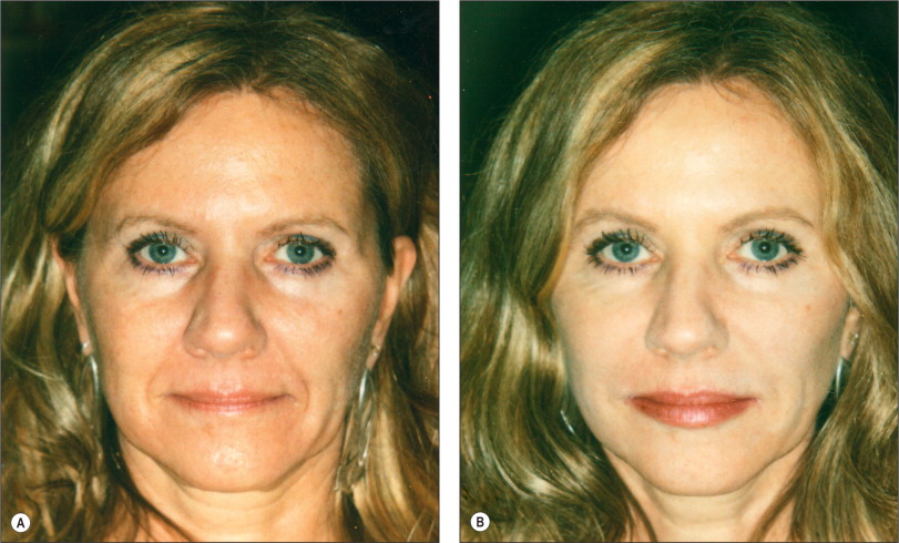 Hyaluronic Acid Filler Injection | Ento Key