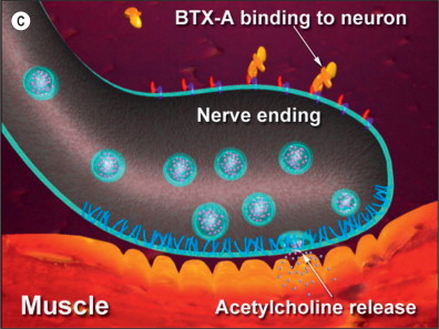 Cosmetic Botulinum Neurotoxin Application | Ento Key