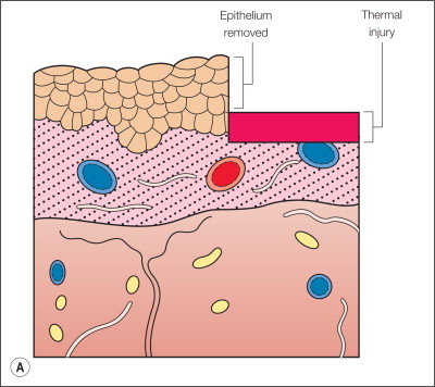 Ablative And Fractionated Laser Skin Resurfacing | Ento Key