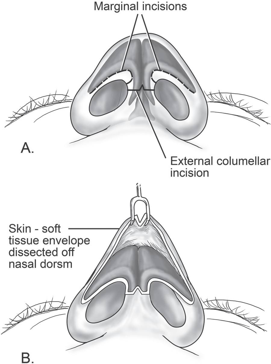 External Approach To The Paranasal Sinuses | Ento Key