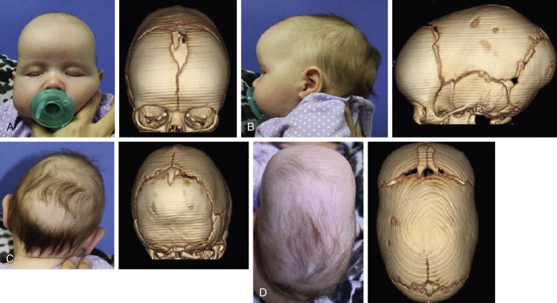 Craniofacial Surgery For Congenital And Acquired Deformities | Ento Key