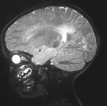 Congenital Malformations Of The Nose And Nasopharynx | Ento Key