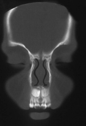 Congenital Malformations Of The Nose And Nasopharynx | Ento Key