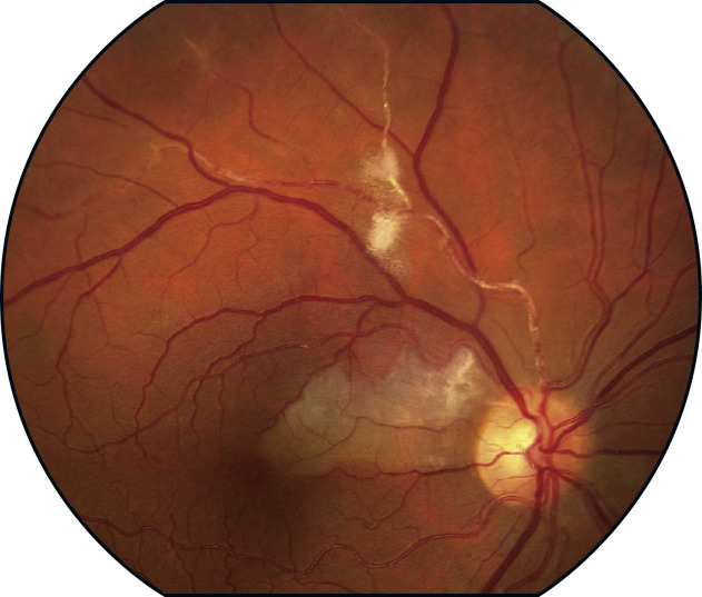 Retinal Vascular Disease | Ento Key