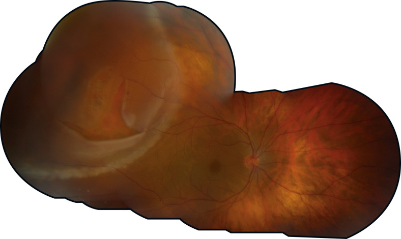 Peripheral Retinal Degenerations And Rhegmatogenous Retinal Detachment ...