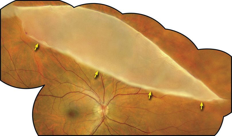 Peripheral Retinal Degenerations And Rhegmatogenous Retinal Detachment ...