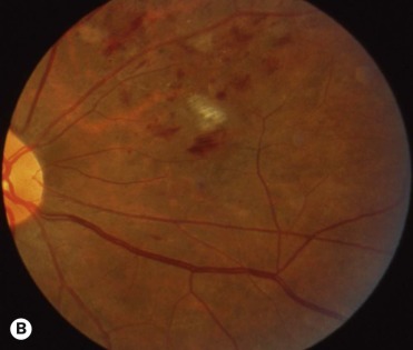 Retinal Vascular Disease | Ento Key