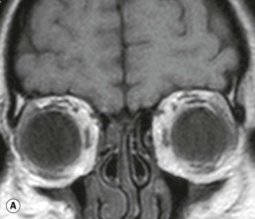 Neuro-ophthalmology | Ento Key