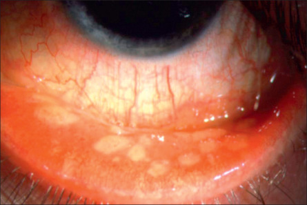 Tumors Of The Conjunctiva | Ento Key