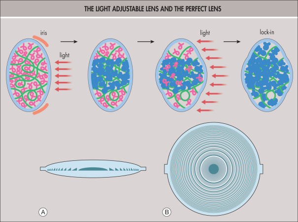 Intraocular Lens Power Calculations | Ento Key