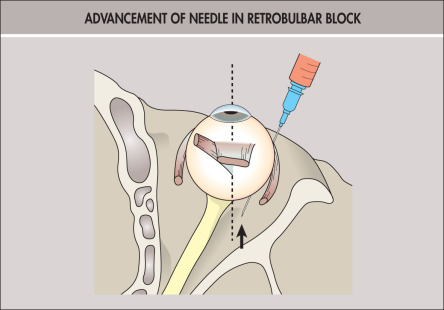 Anesthesia For Cataract Surgery | Ento Key