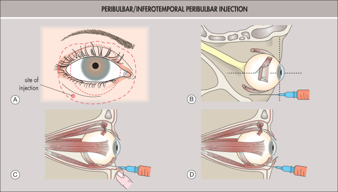 Anesthesia For Cataract Surgery | Ento Key